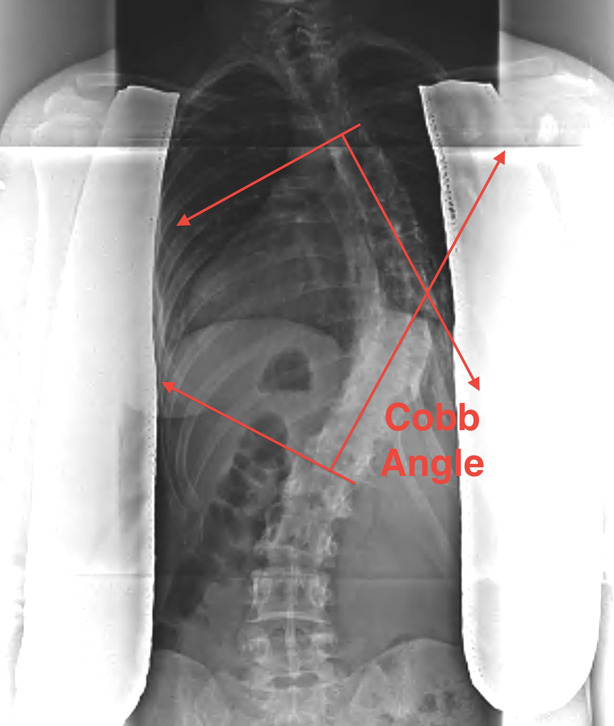 Scoliosis Cobb Angle